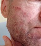 Красные прыщи на лице фото 2