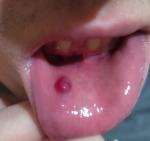 Шишка под губой фото 1