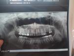 Болит зуб на протяжении 8 месяцев фото 1