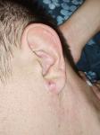 Воспаление на мочке уха фото 1