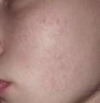 Дерматит на щеках фото 1