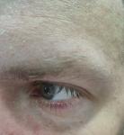 Белый прыщик на веке фото 1