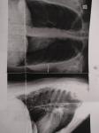 Возможно, что я перенесла пневманию, и на рентгене её последствия фото 1