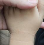 Высыпание бугристое на левой руке фото 3