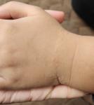 Высыпание бугристое на левой руке фото 5