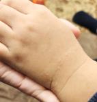 Высыпание бугристое на левой руке фото 4