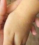 Высыпание бугристое на левой руке фото 1