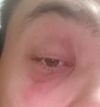 Подскажите, пожалуйста как вылечить коньюктевит? фото 4