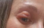 Волдыри на веке фото 1