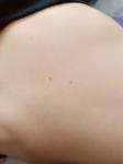 Родинка, гемангиома, папиллома или что-то серьёзное фото 2