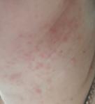 Сыпь на шее более 7 месяцев фото 3