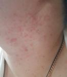 Сыпь на шее более 7 месяцев фото 2