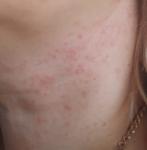 Сыпь на шее более 7 месяцев фото 1