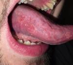 Плями збоку язика фото 2