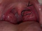 Опухоль в горле на миндалине фото 2