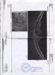 Макулодистрофия сетчатки глаза - лечение фото 4
