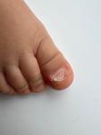Расслоение ногтей ребенок 1 год, пятна на ступнях фото 3