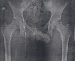 Тазобедренные суставы рентген фото 1