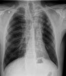 Рентген диагностика на туберкулез фото 1