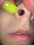Кровотечение из носа, шаровидная припухлость в ноздре фото 1