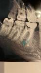Гранулема зуба фото 1