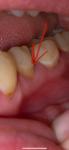 Пломба после чистки зубов фото 1