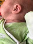 Сыпь на щечках у ребёнка фото 1