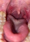 Ком в горле, увеличены ли миндалины фото 1