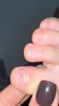 Коричневое пятнышко на ногте ноги фото 3