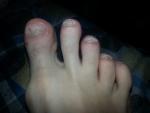 Грибок ногтей на ногах лечение фото 1