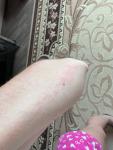 Сыпь на внутренней стороне рук летом/ при смене места фото 2