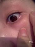 Около моих глаз выросли белые шишки. Помогите пожалуйста! фото 1