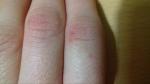 Трещины на сгибах пальцев рук фото 1
