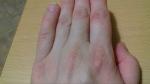 Трещины на сгибах пальцев рук фото 2
