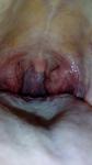 Болит горло, шишки на миндалина фото 1