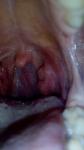 Болит горло, шишки на миндалина фото 2