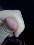 Незаживающие трещинки на большом пальце руки фото 1