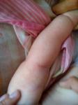 Выступила сыпь на сгибах у ребенка в 6 месяцев фото 2