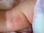 Выступила сыпь на сгибах у ребенка в 6 месяцев фото 3