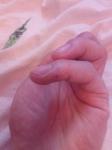 Сухие бляшки с трещинами на тыльной стороне пальцев рук фото 1