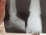 Перелом основания 5-й плюсневой кости фото 1
