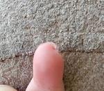 Нарост рядом с мицинцем руки фото 1