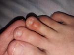 Мягкая шишка на пальцах ног фото 2