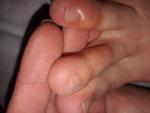 Мягкая шишка на пальцах ног фото 1