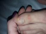 Мягкая шишка на пальцах ног фото 3