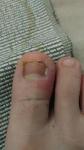 Опух большой палец ноги и нарывает сбоку ногтя фото 1