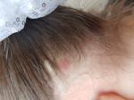Красная шишка на голове у ребенка фото 2
