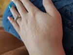 Сыпь (аллергия) на руках. Не проходит фото 1