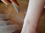 Сыпь (аллергия) на руках. Не проходит фото 2