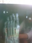 Отрывной перелом пальца ноги фото 2